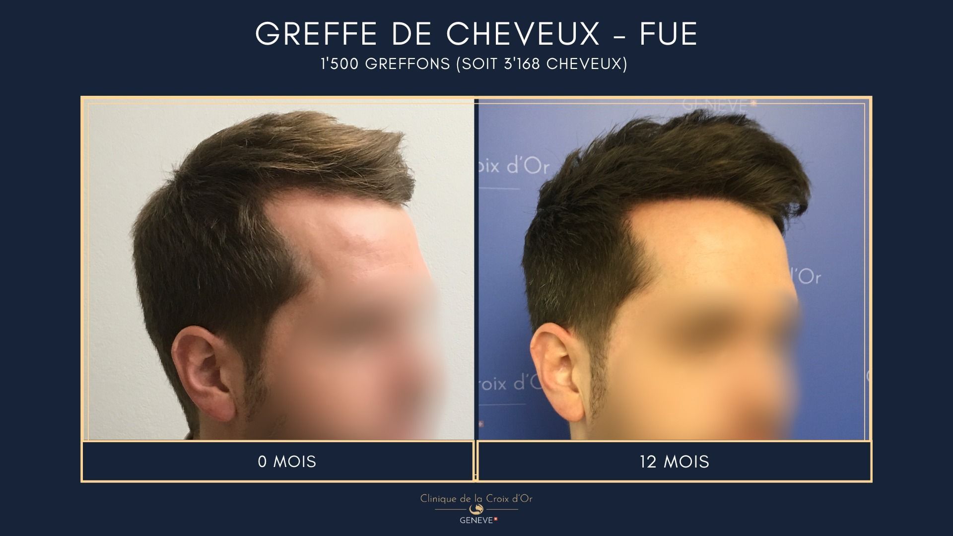 Greffe de cheveux - FUE