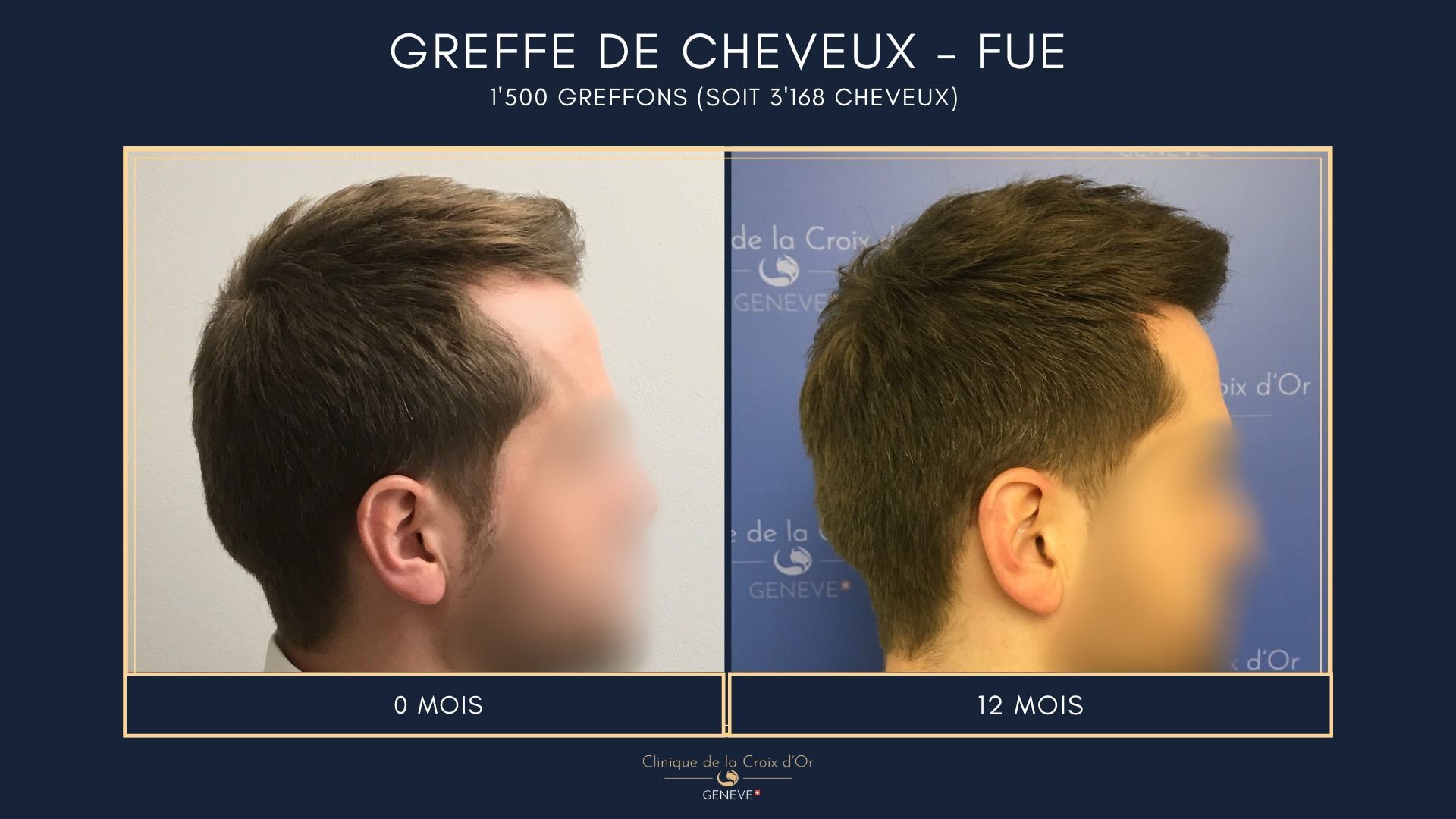 Greffe de cheveux - FUE