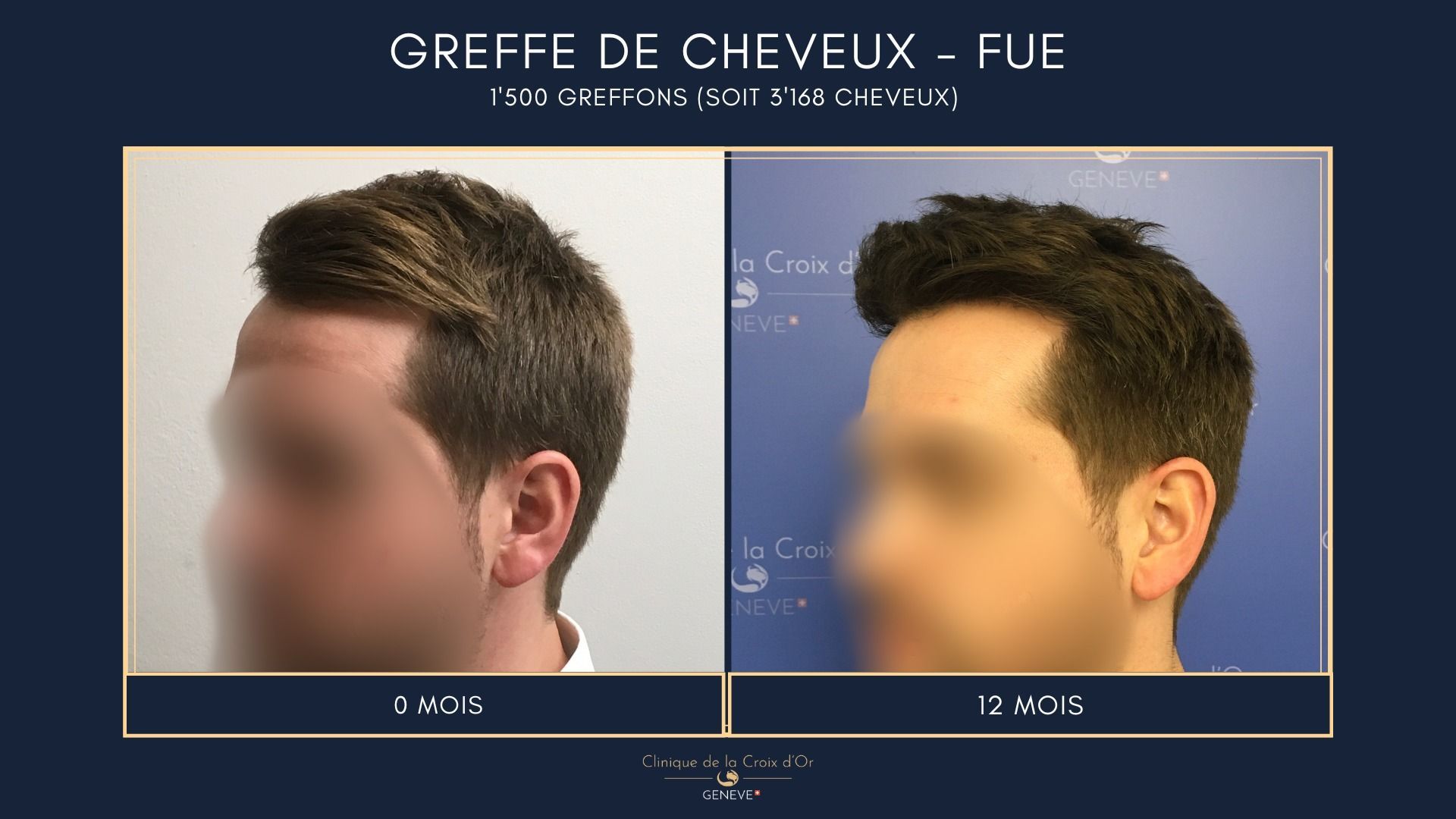 Greffe de cheveux - FUE