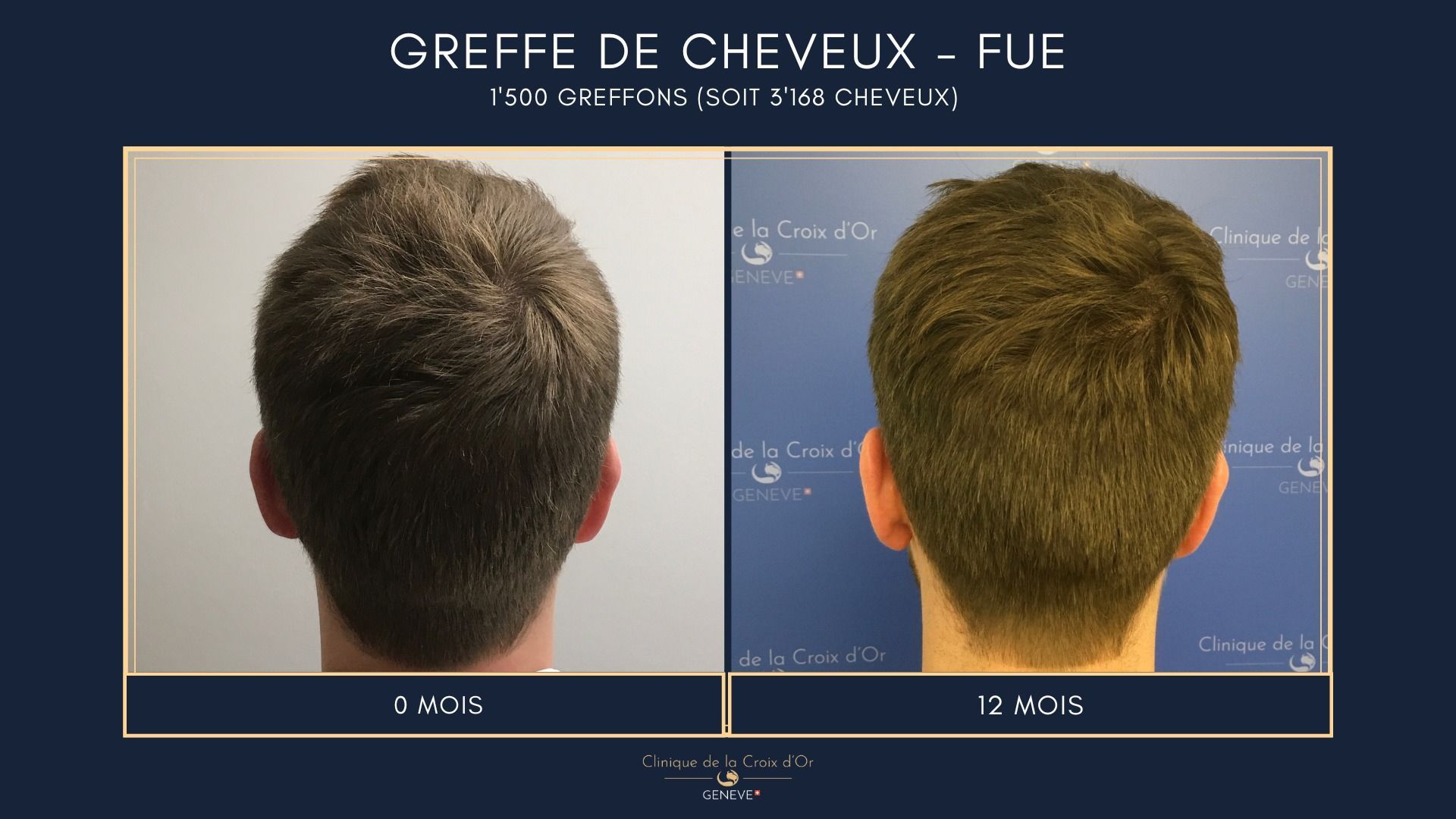 Greffe de cheveux - FUE