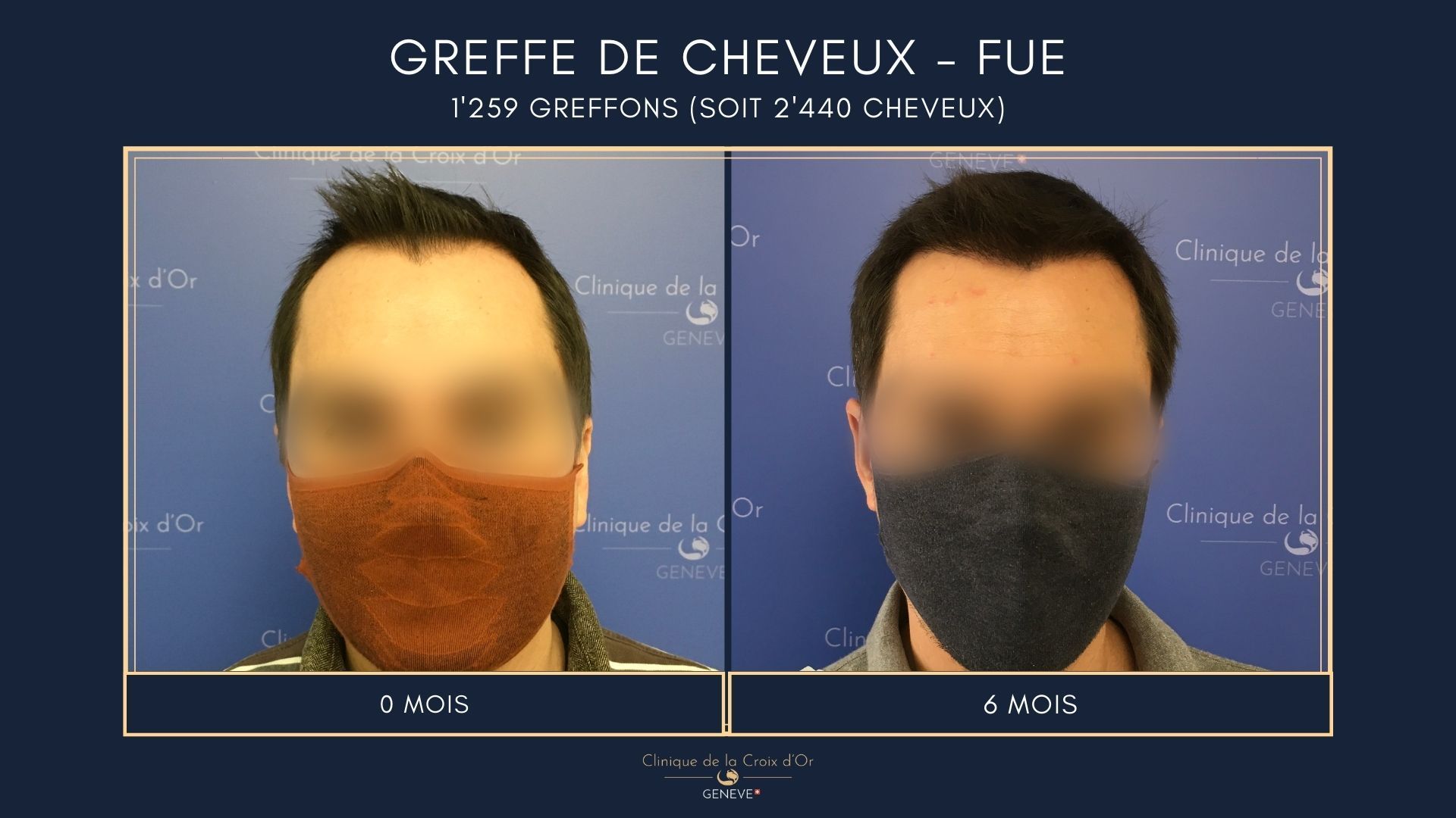 Greffe de cheveux - FUE