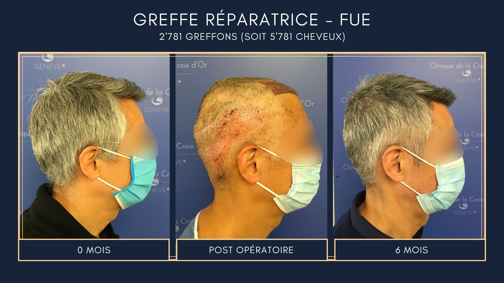 Greffe capillaire réparatrice ou correctrice