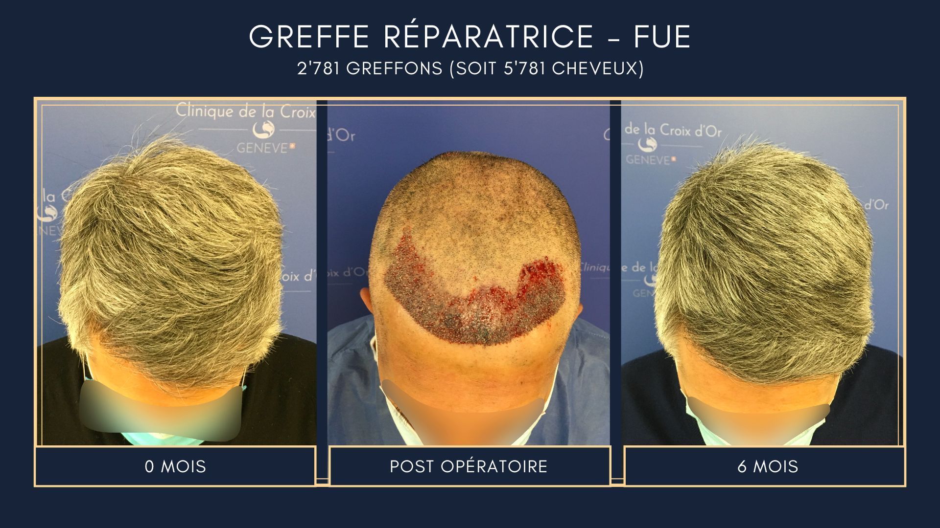 Greffe capillaire réparatrice ou correctrice