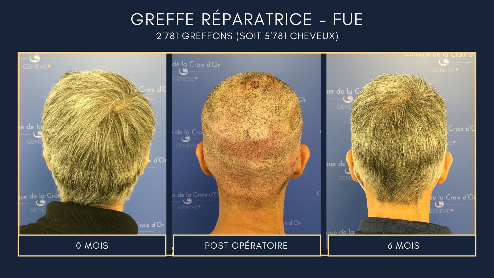 Greffe capillaire réparatrice ou correctrice