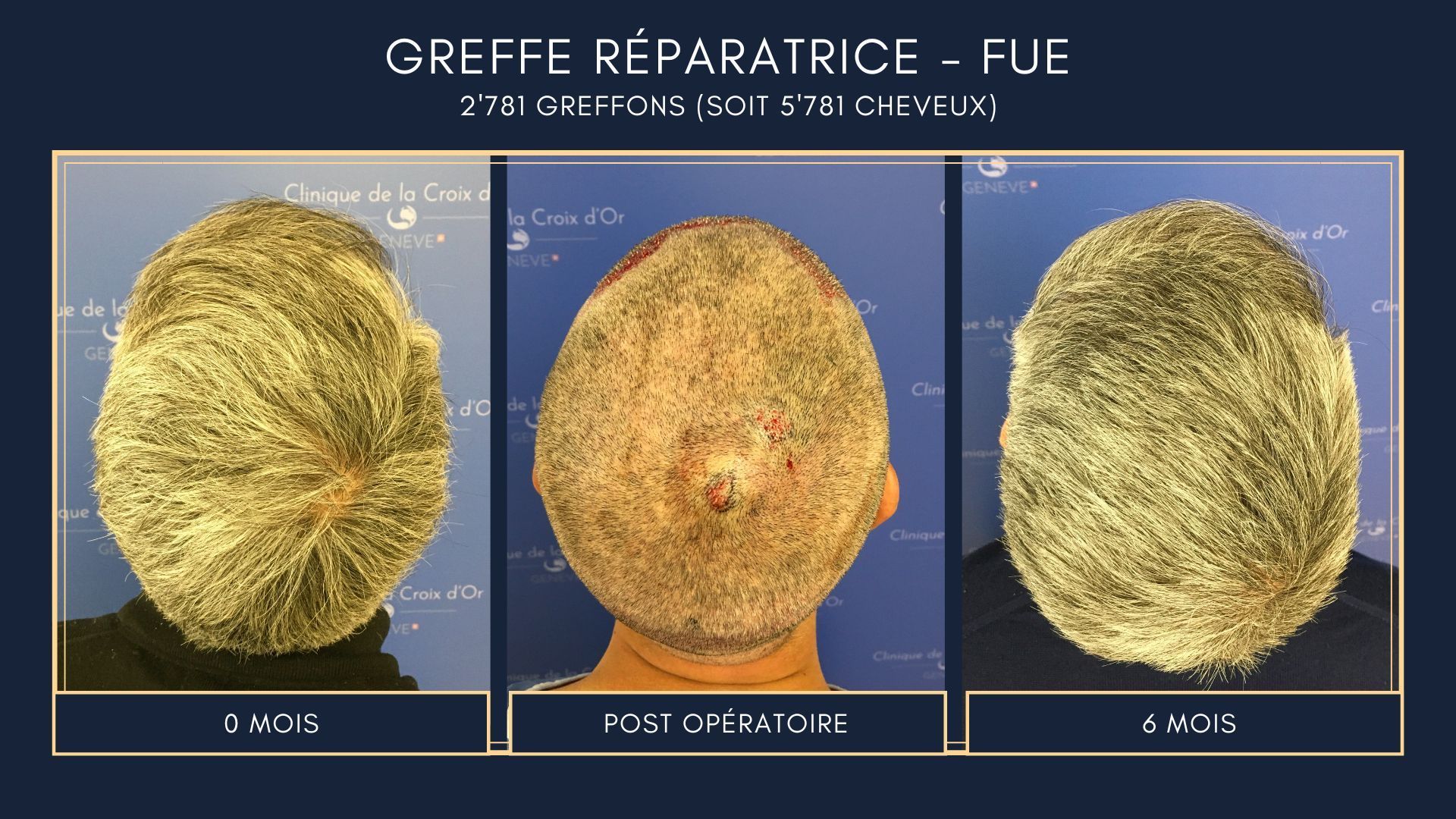 Greffe capillaire réparatrice ou correctrice