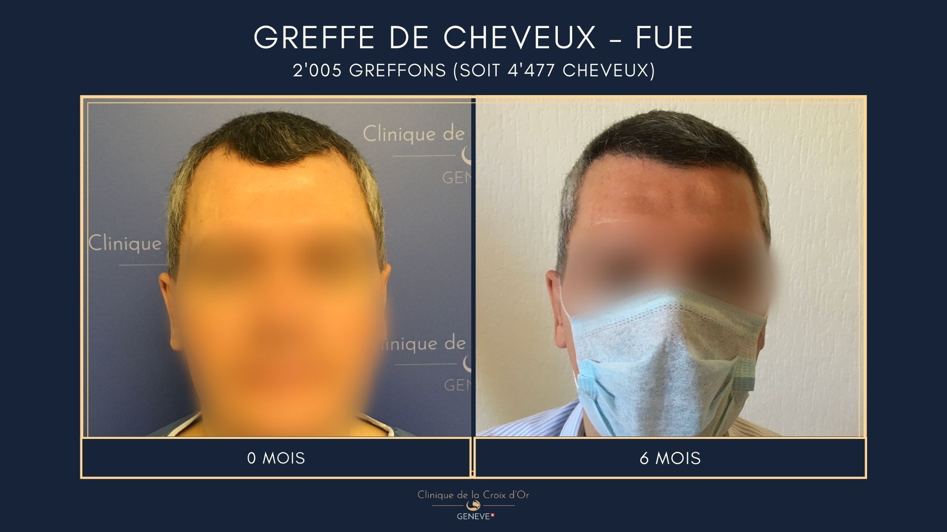Greffe de cheveux - FUE