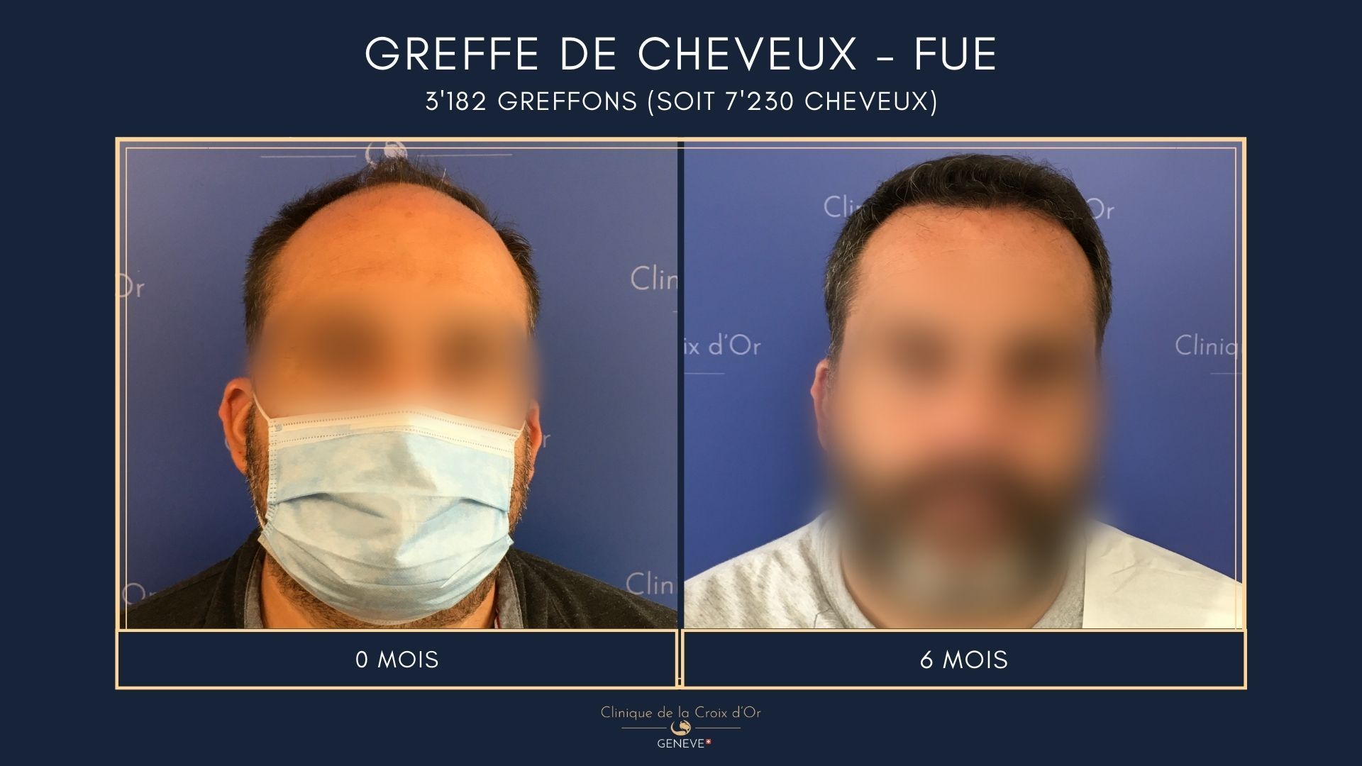Greffe de cheveux - FUE
