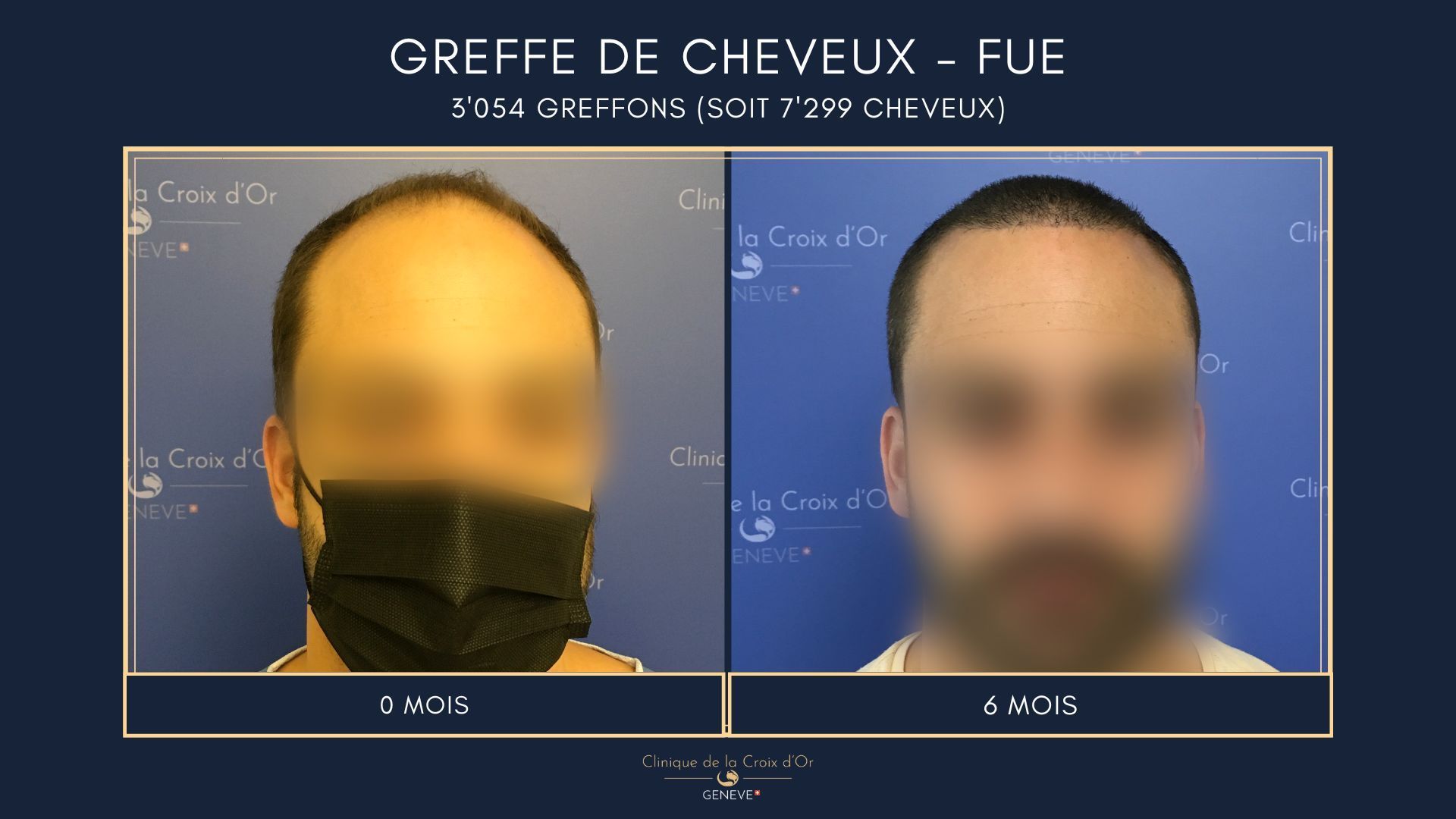 Greffe de cheveux - FUE