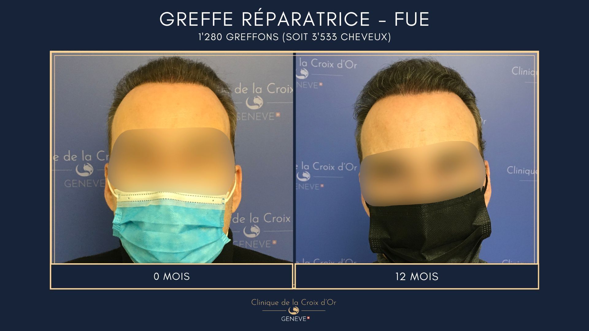 Greffe capillaire réparatrice ou correctrice