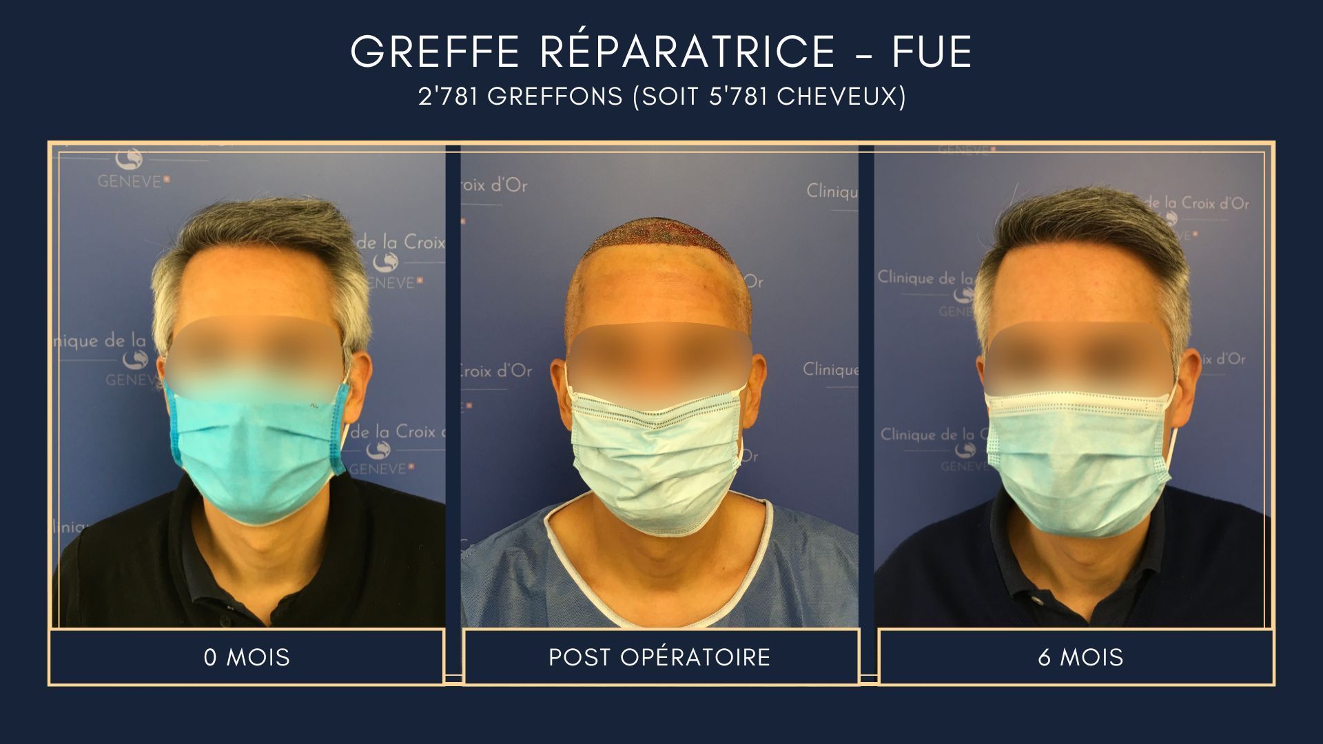 Greffe capillaire réparatrice ou correctrice