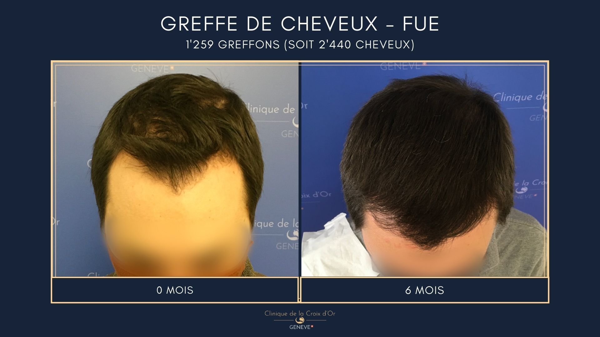 Greffe de cheveux - FUE