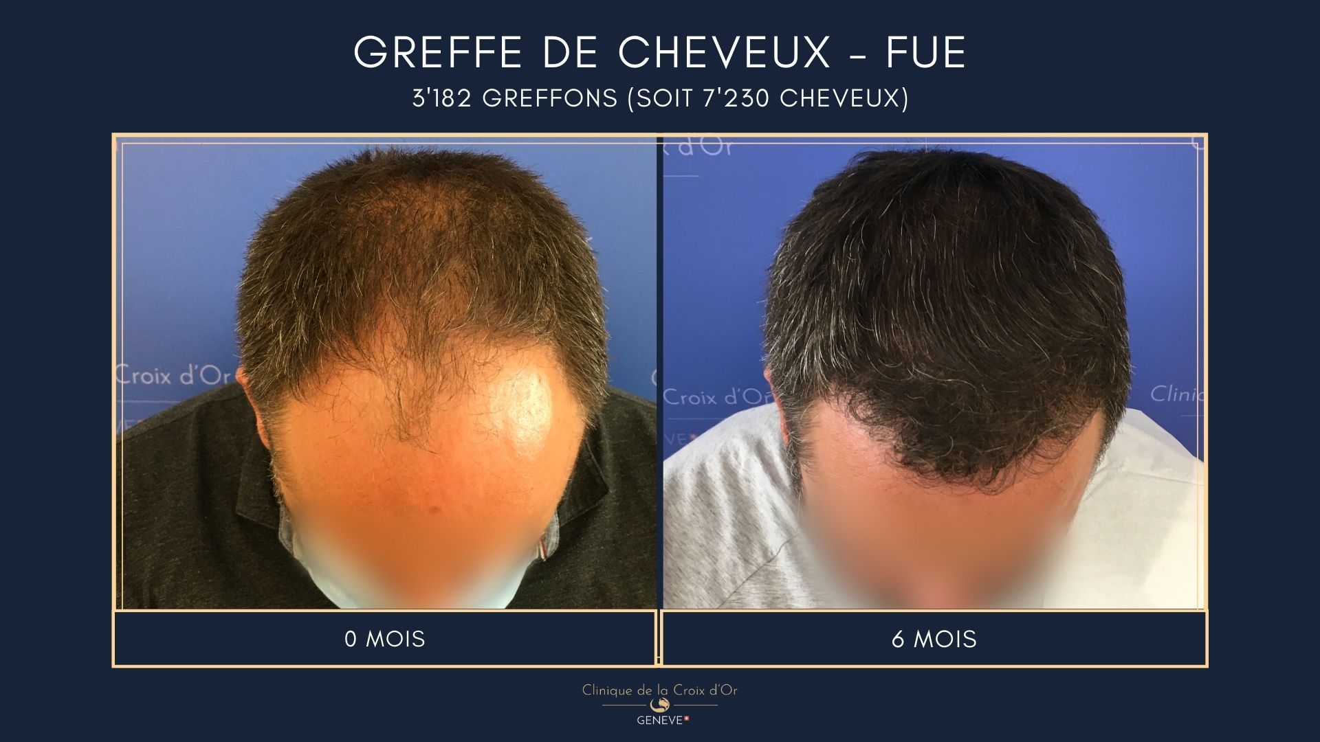 Greffe de cheveux - FUE