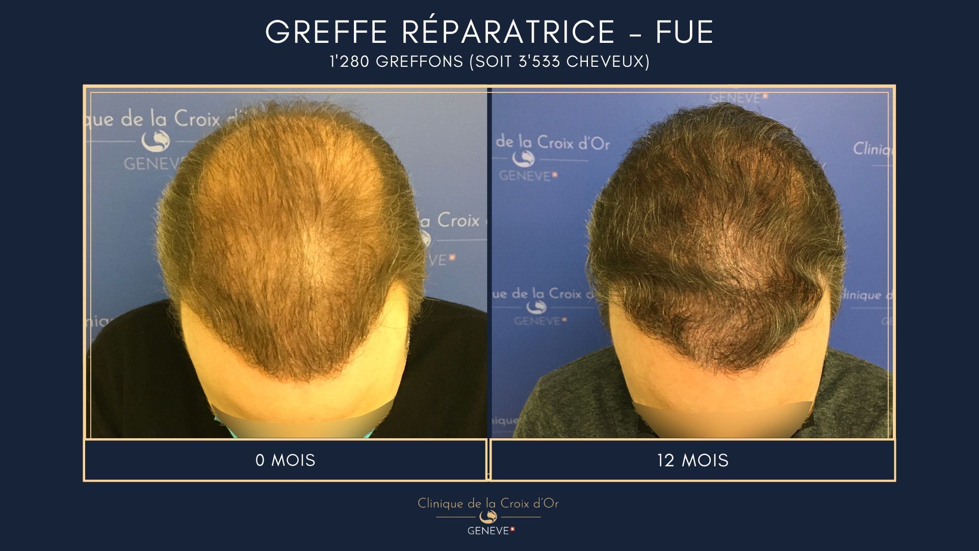 Greffe capillaire réparatrice ou correctrice