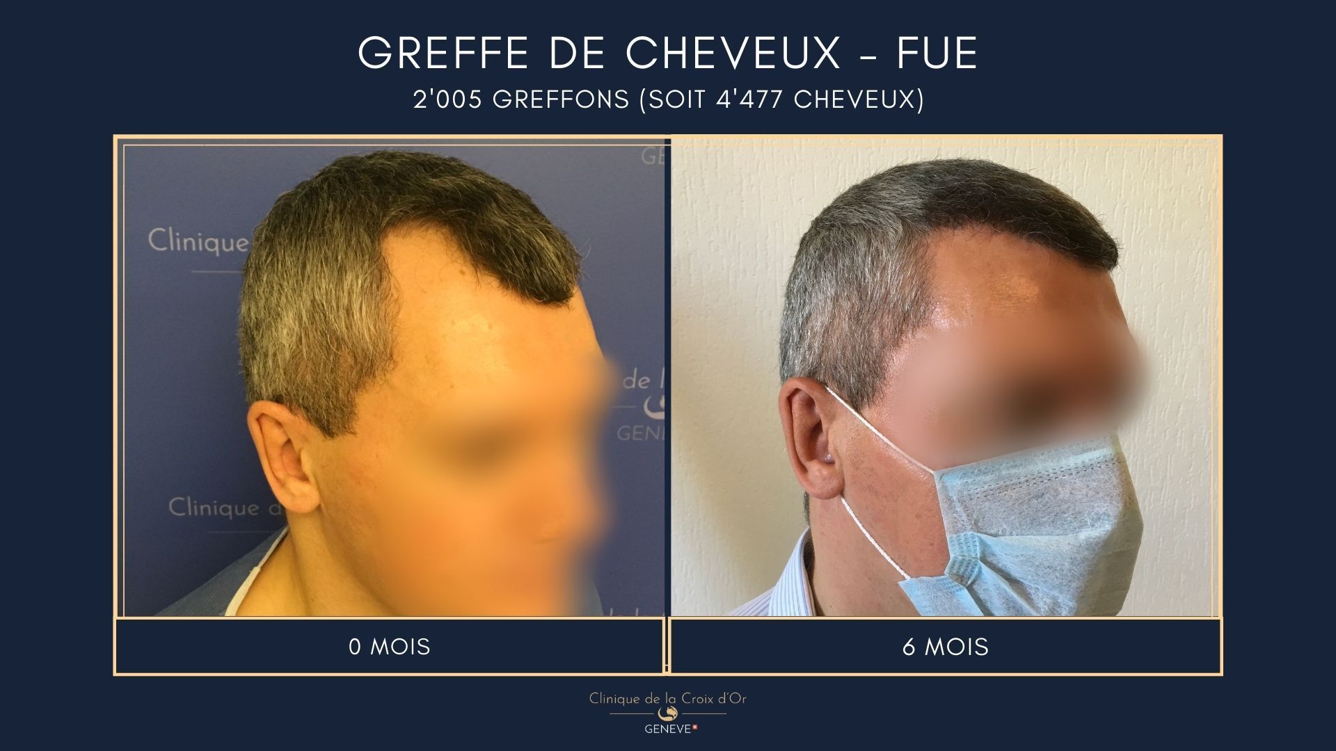 Greffe de cheveux - FUE