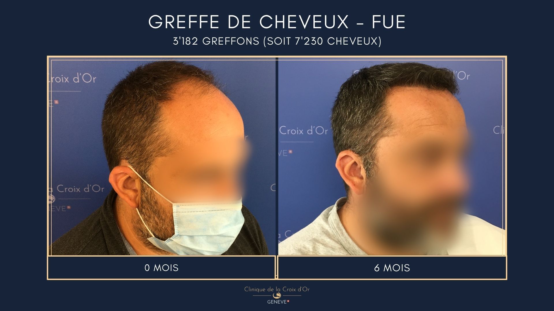 Greffe de cheveux - FUE