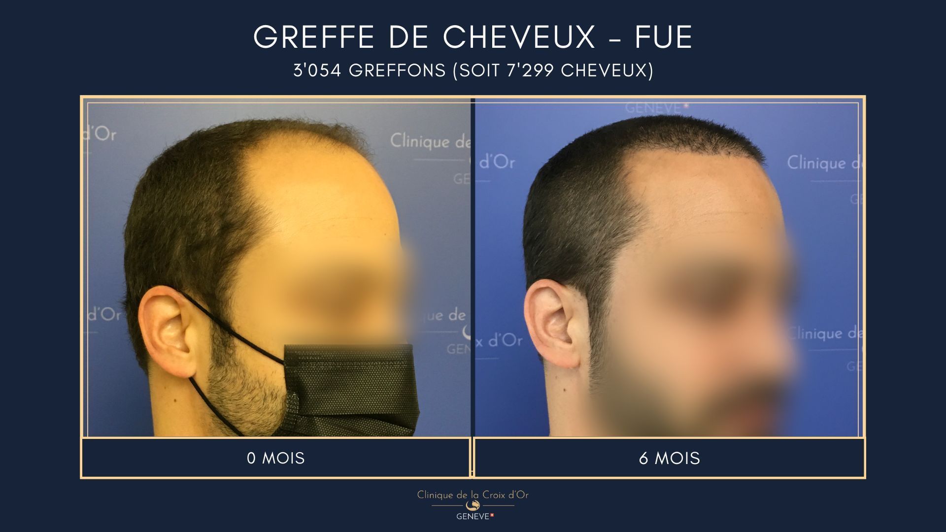 Greffe de cheveux - FUE