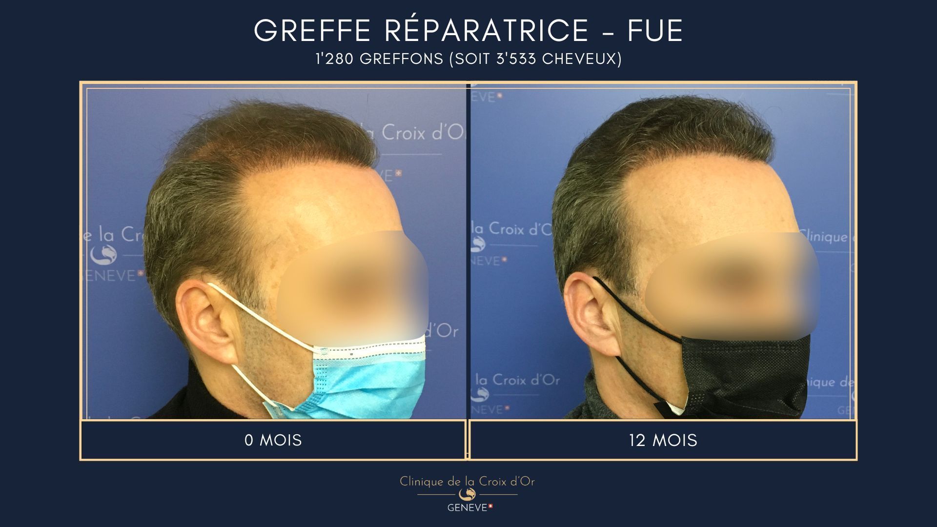 Greffe capillaire réparatrice ou correctrice