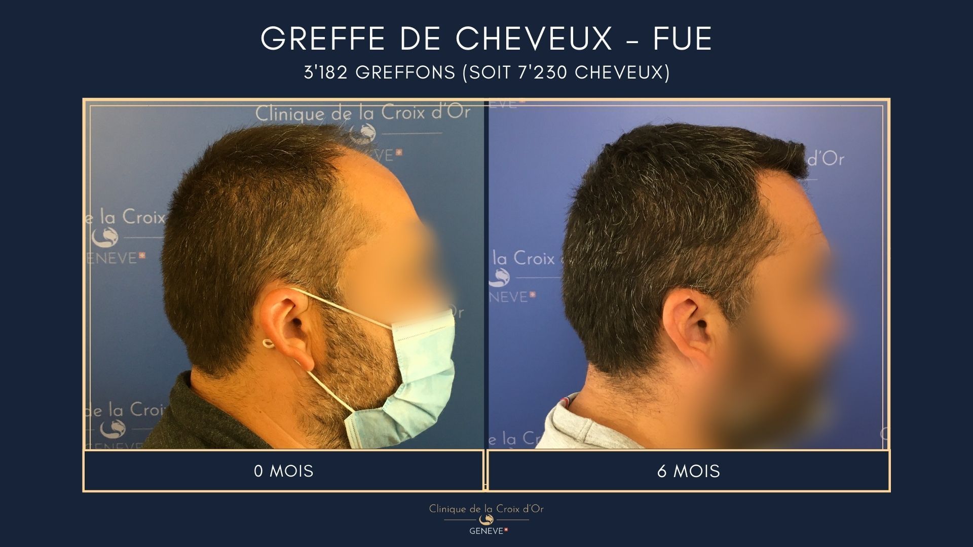 Greffe de cheveux - FUE