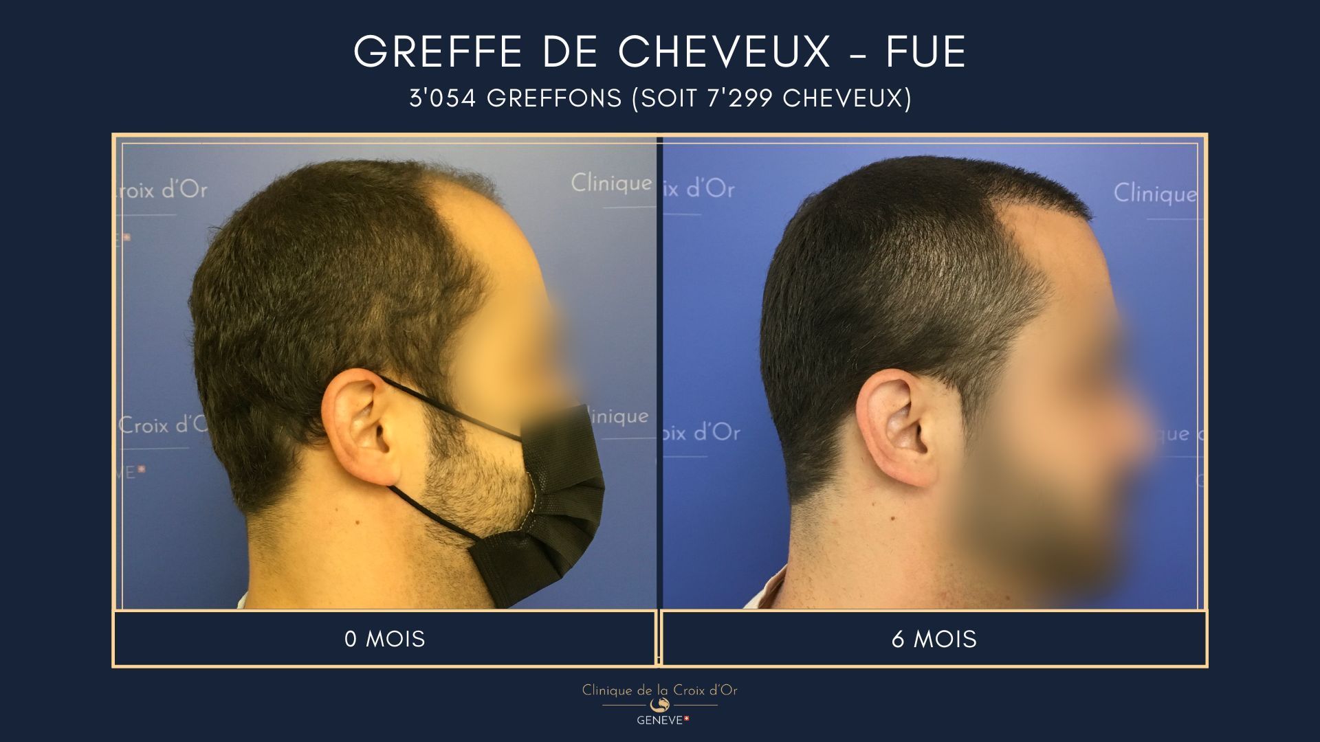 Greffe de cheveux - FUE