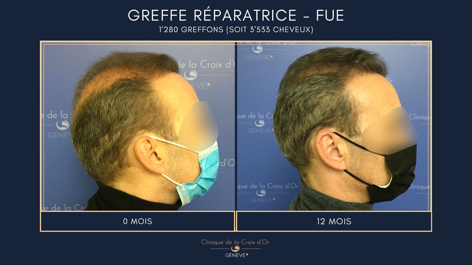 Greffe capillaire réparatrice ou correctrice