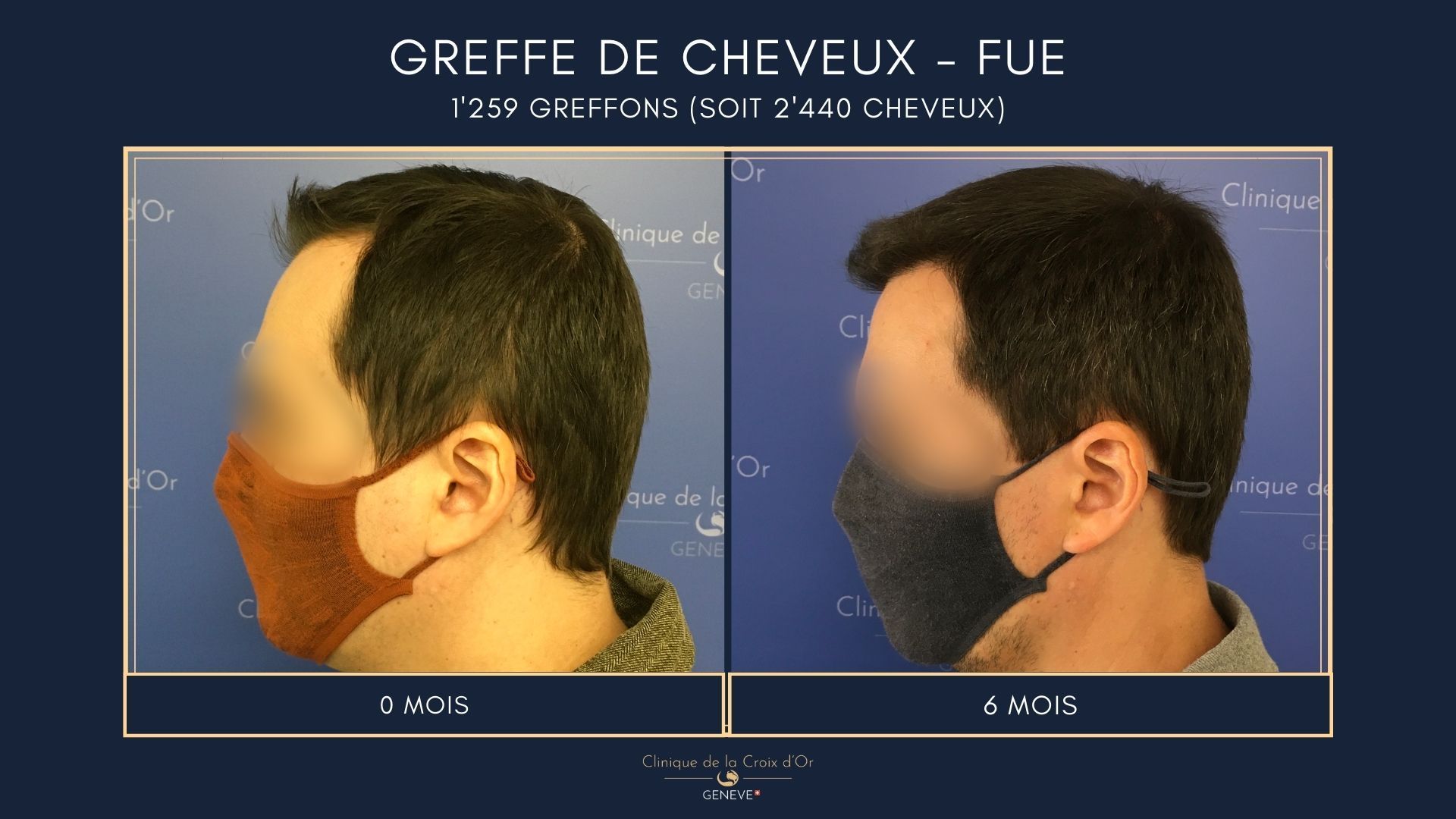Greffe de cheveux - FUE