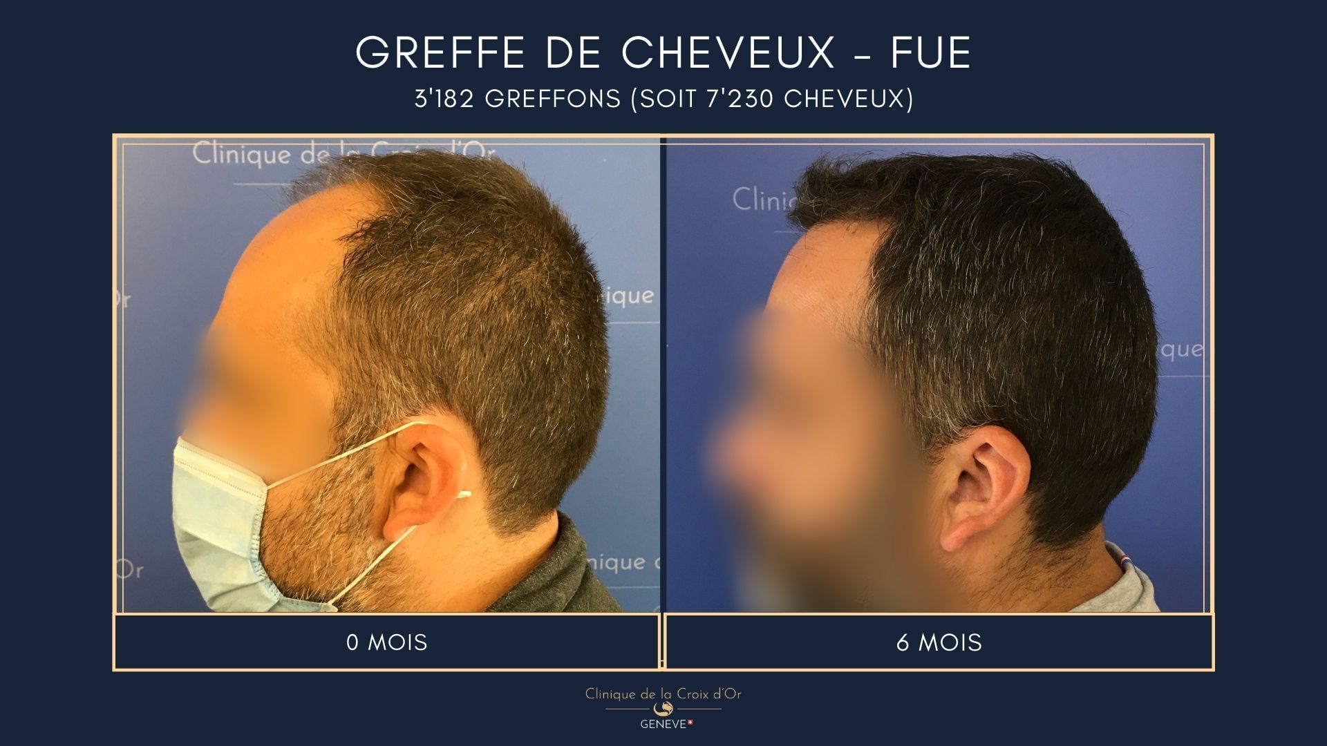 Greffe de cheveux - FUE