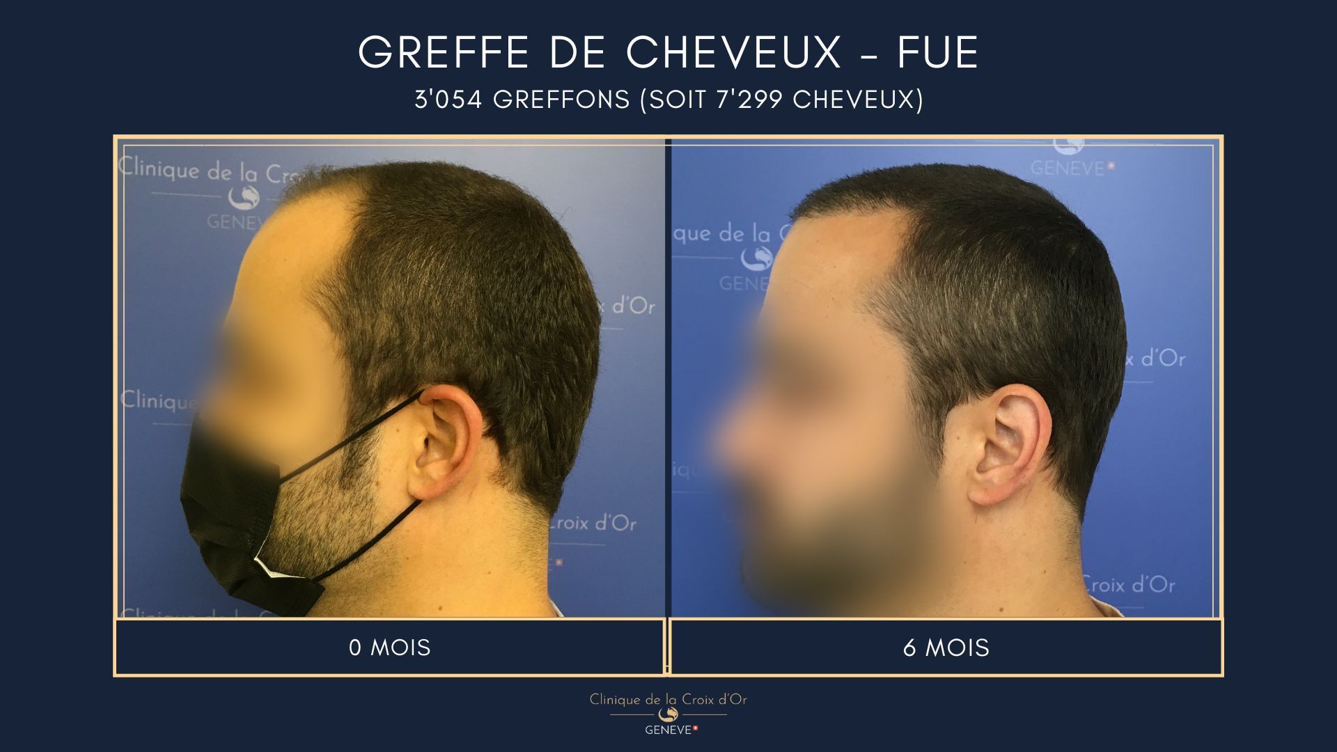 Greffe de cheveux - FUE