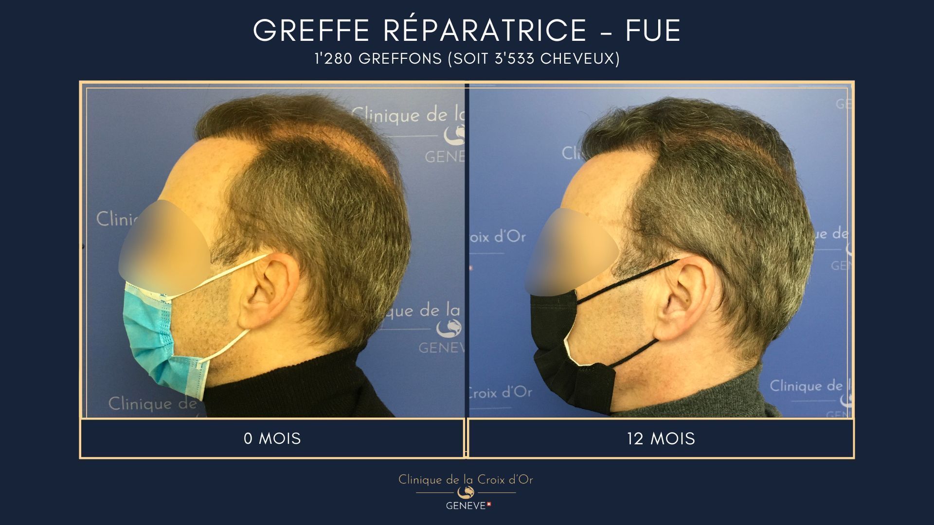 Greffe capillaire réparatrice ou correctrice