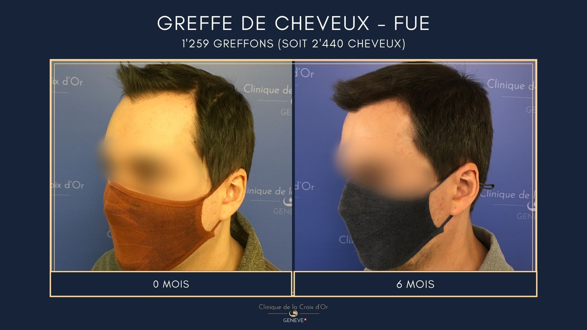 Greffe de cheveux - FUE
