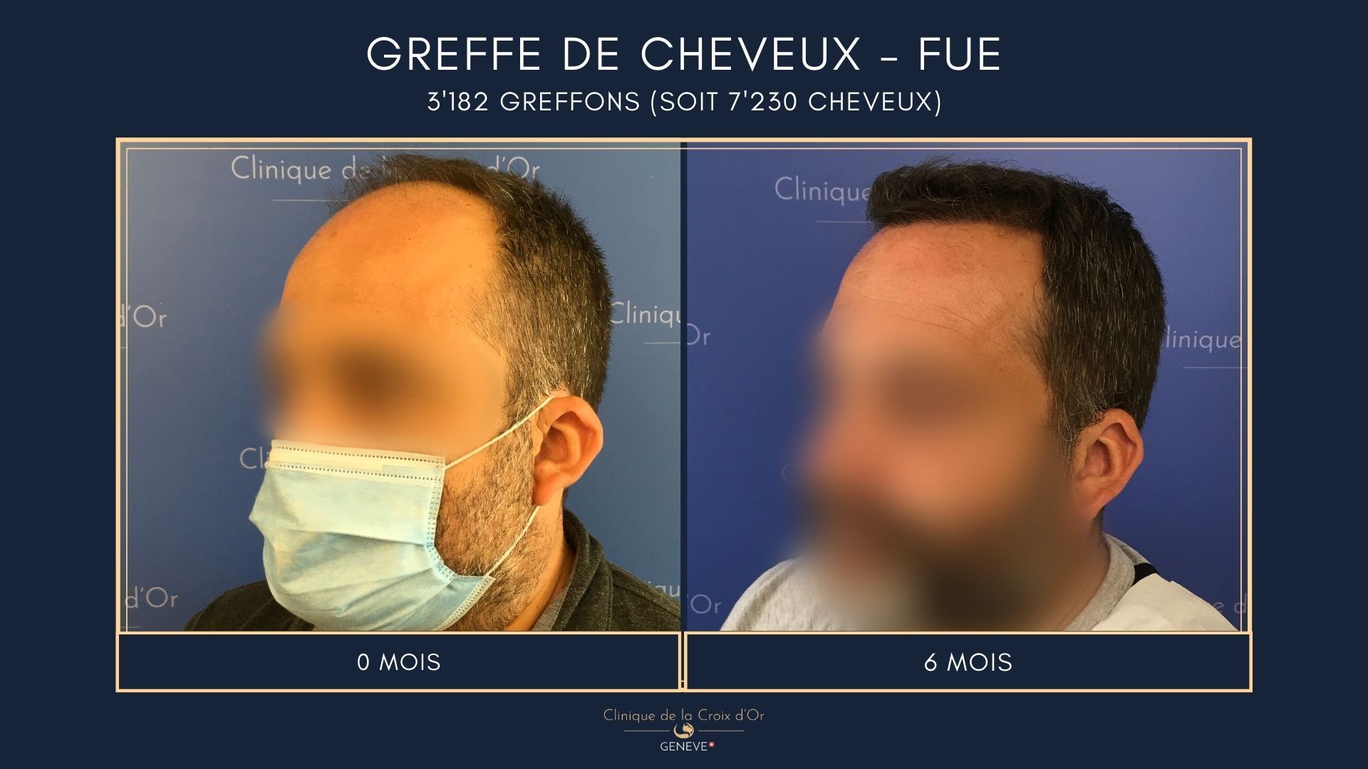 Greffe de cheveux - FUE
