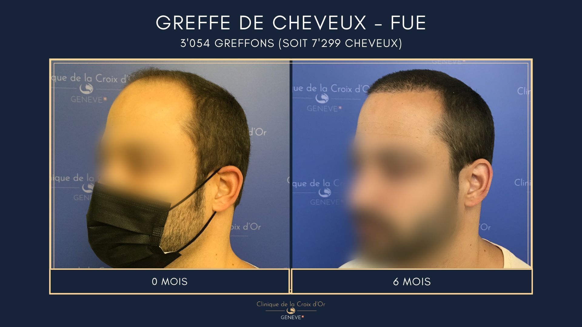 Greffe de cheveux - FUE