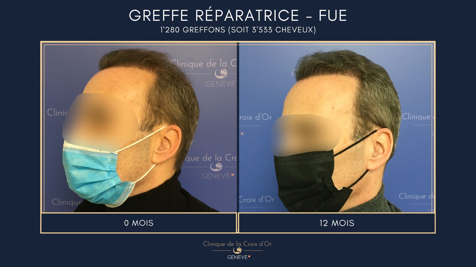 Greffe capillaire réparatrice ou correctrice