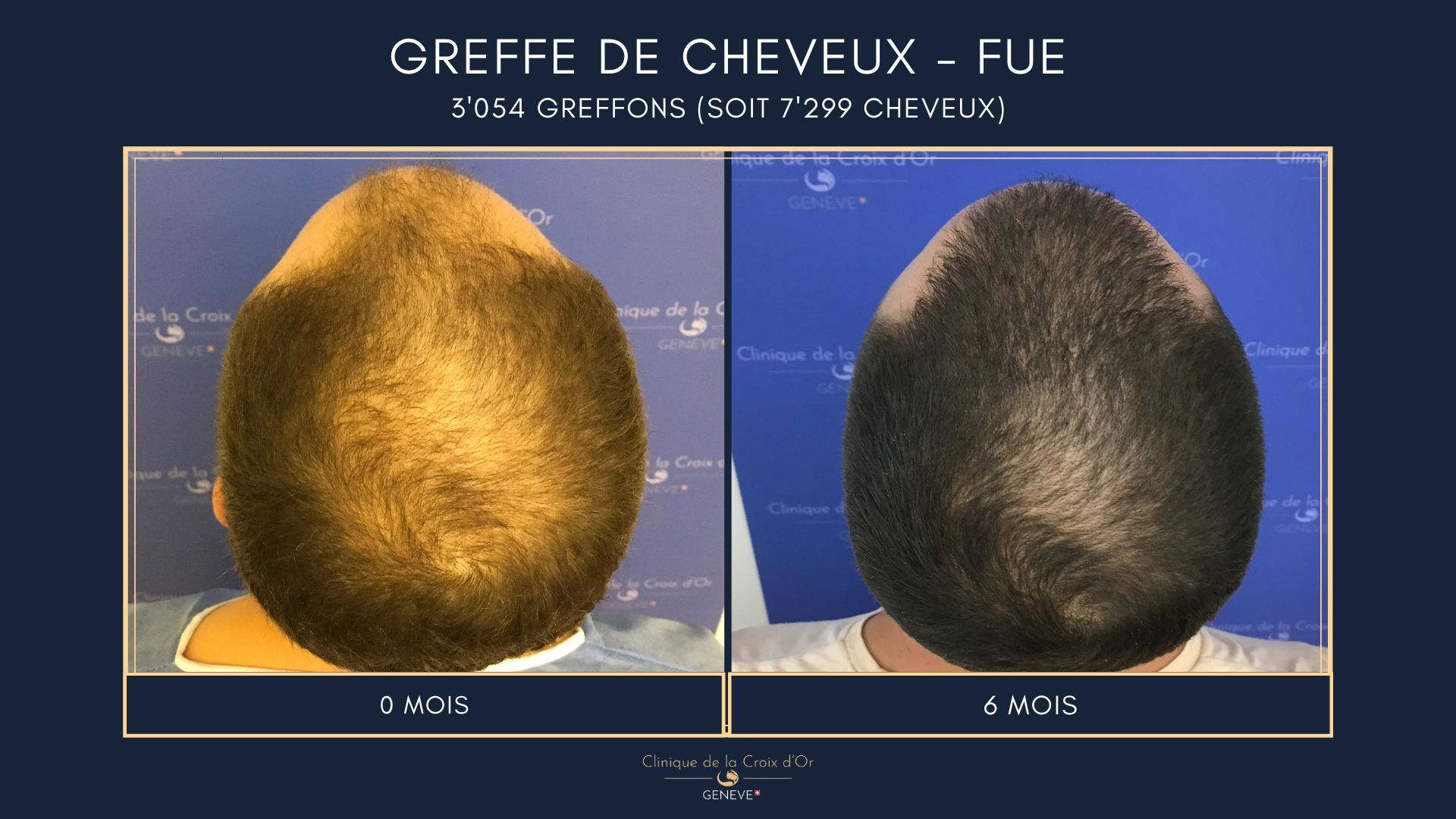 Greffe de cheveux - FUE