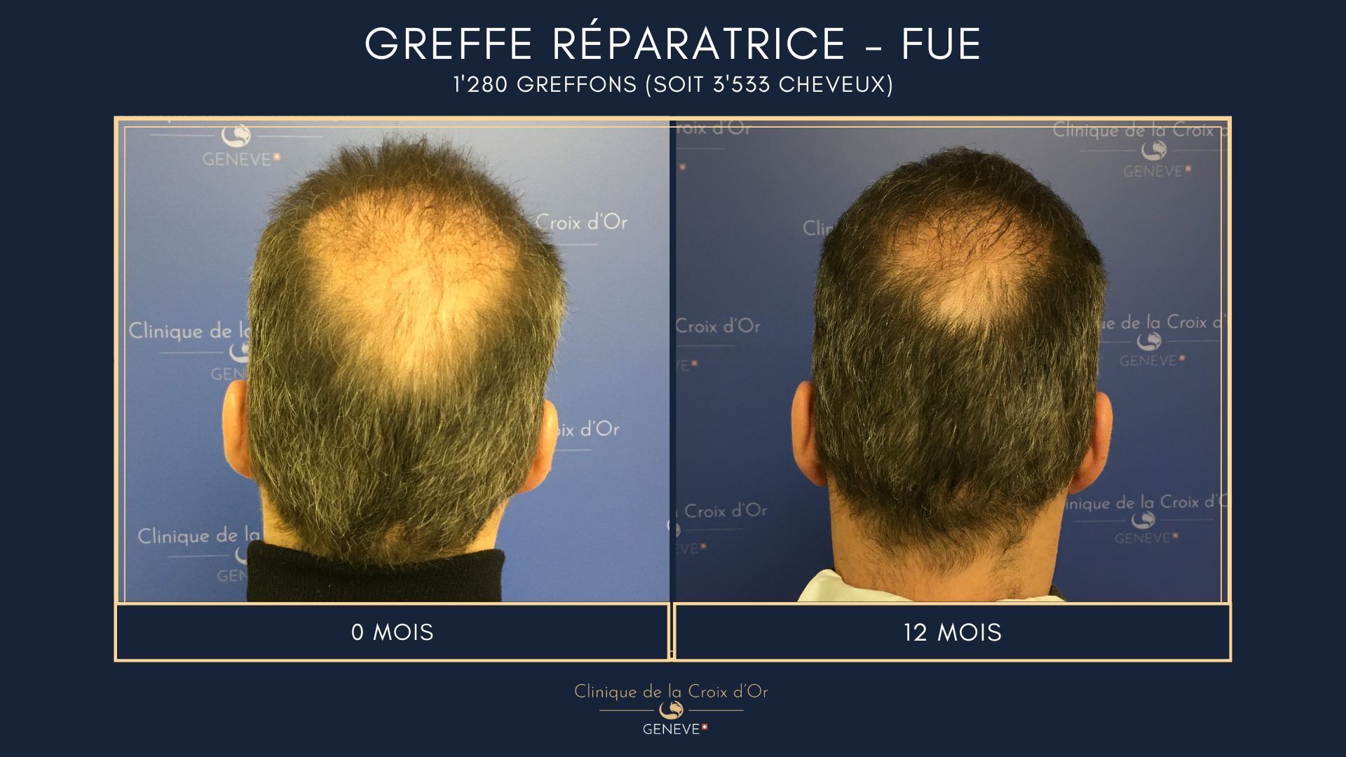 Greffe capillaire réparatrice ou correctrice