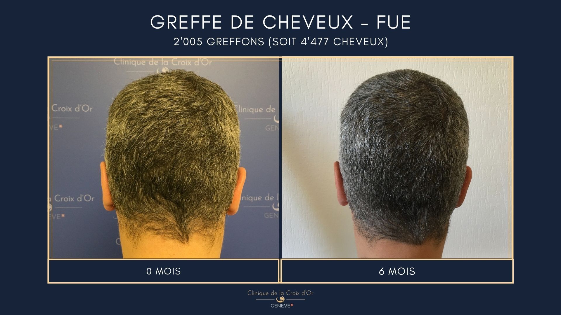 Greffe de cheveux - FUE