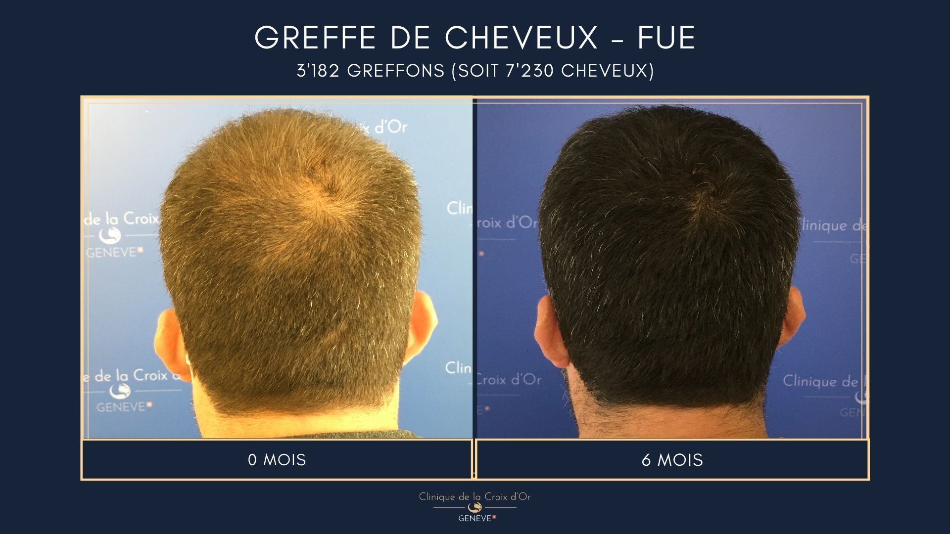 Greffe de cheveux - FUE