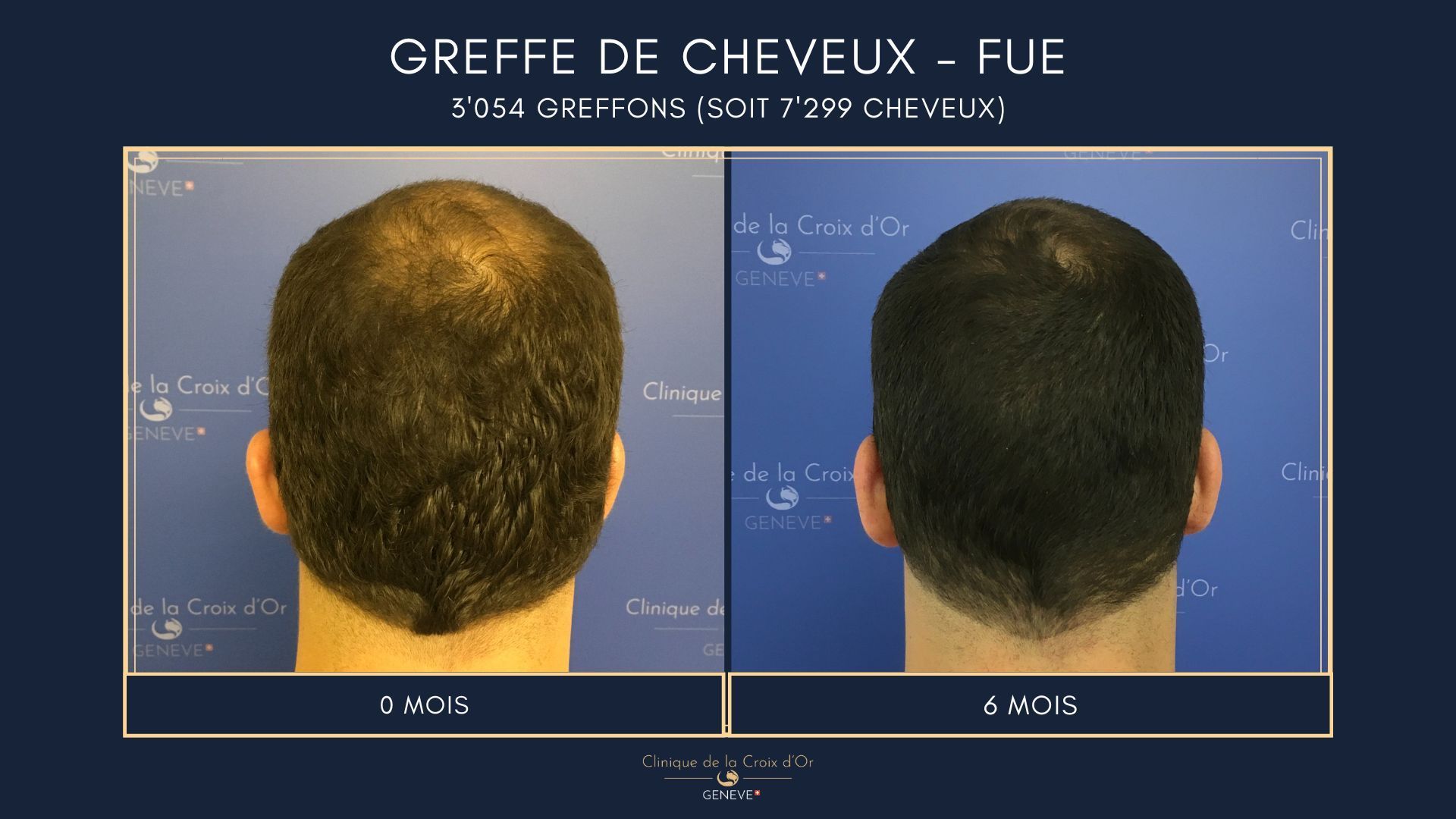 Greffe de cheveux - FUE
