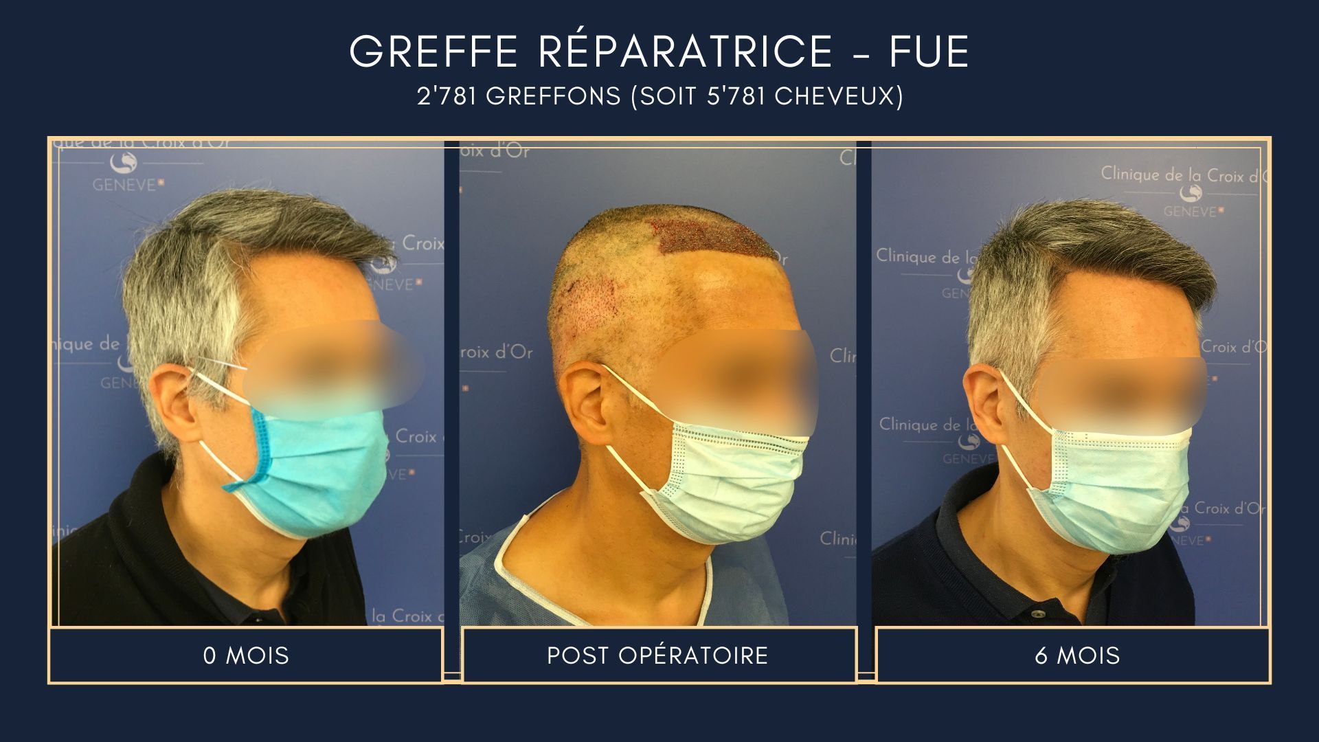 Greffe capillaire réparatrice ou correctrice