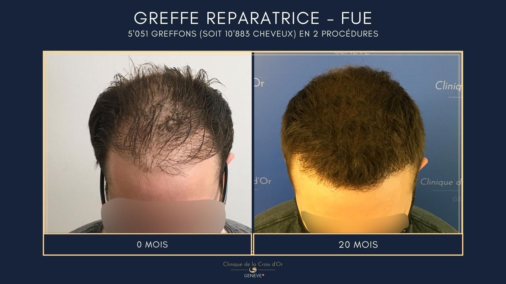 Greffe capillaire réparatrice ou correctrice