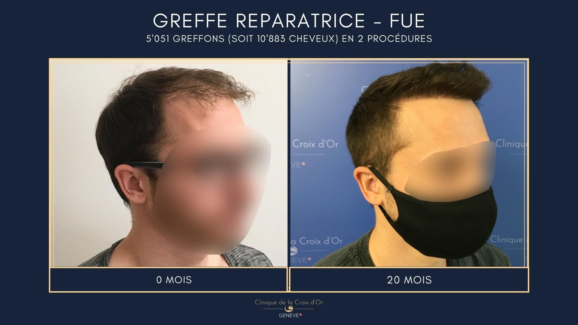 Greffe capillaire réparatrice ou correctrice