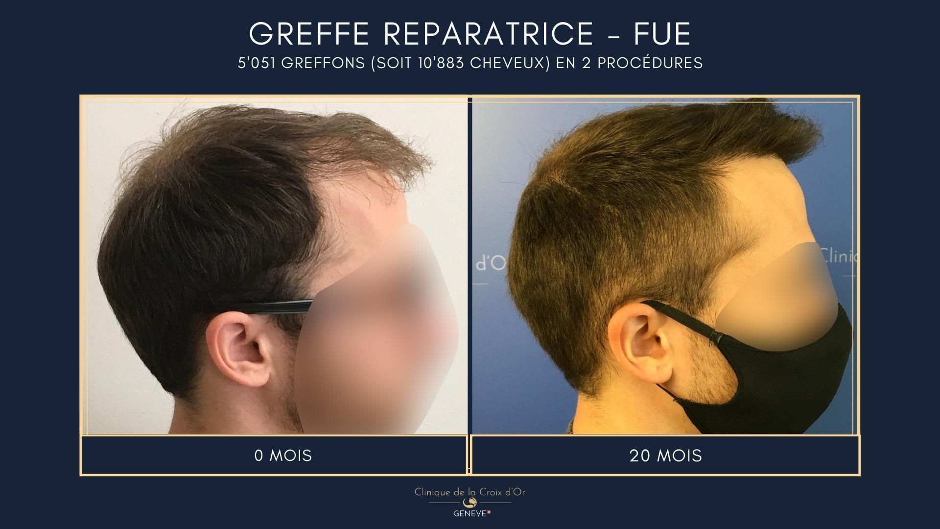 Greffe capillaire réparatrice ou correctrice