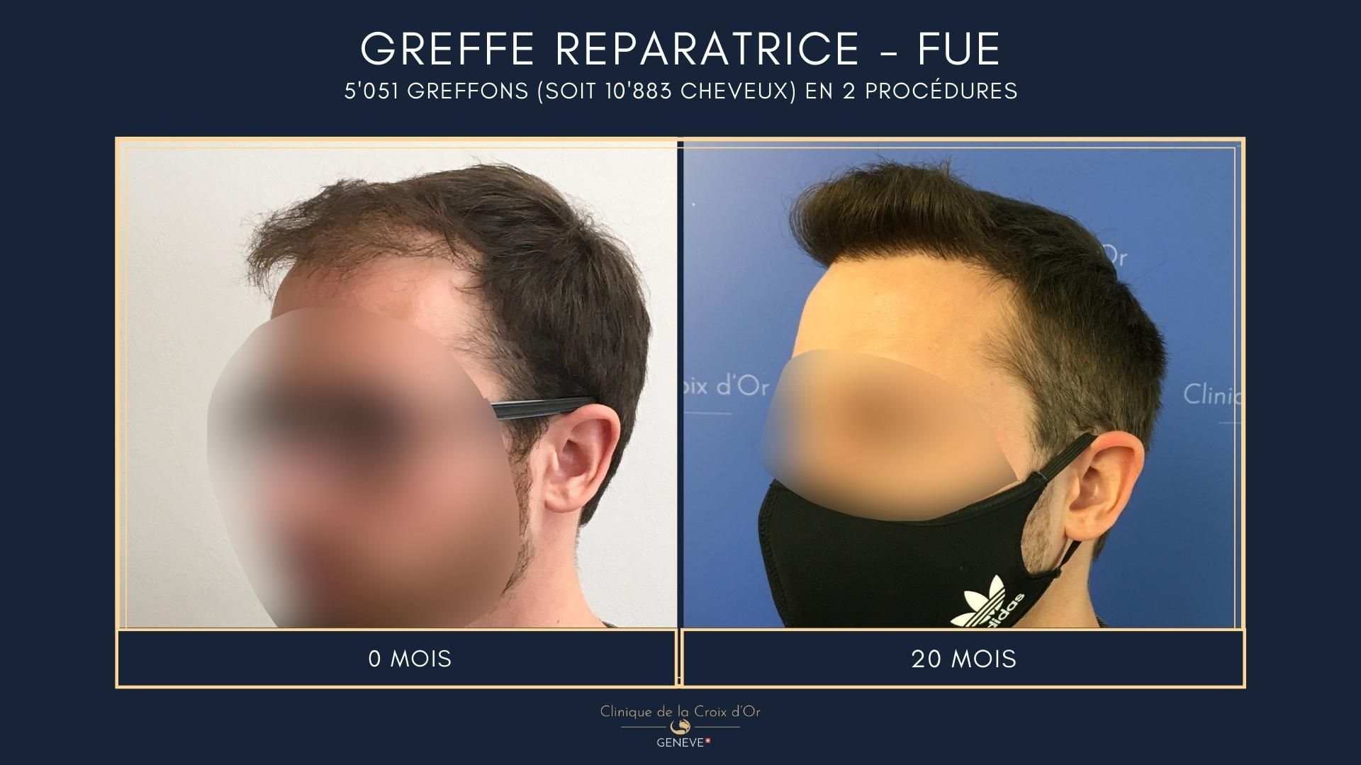 Greffe capillaire réparatrice ou correctrice