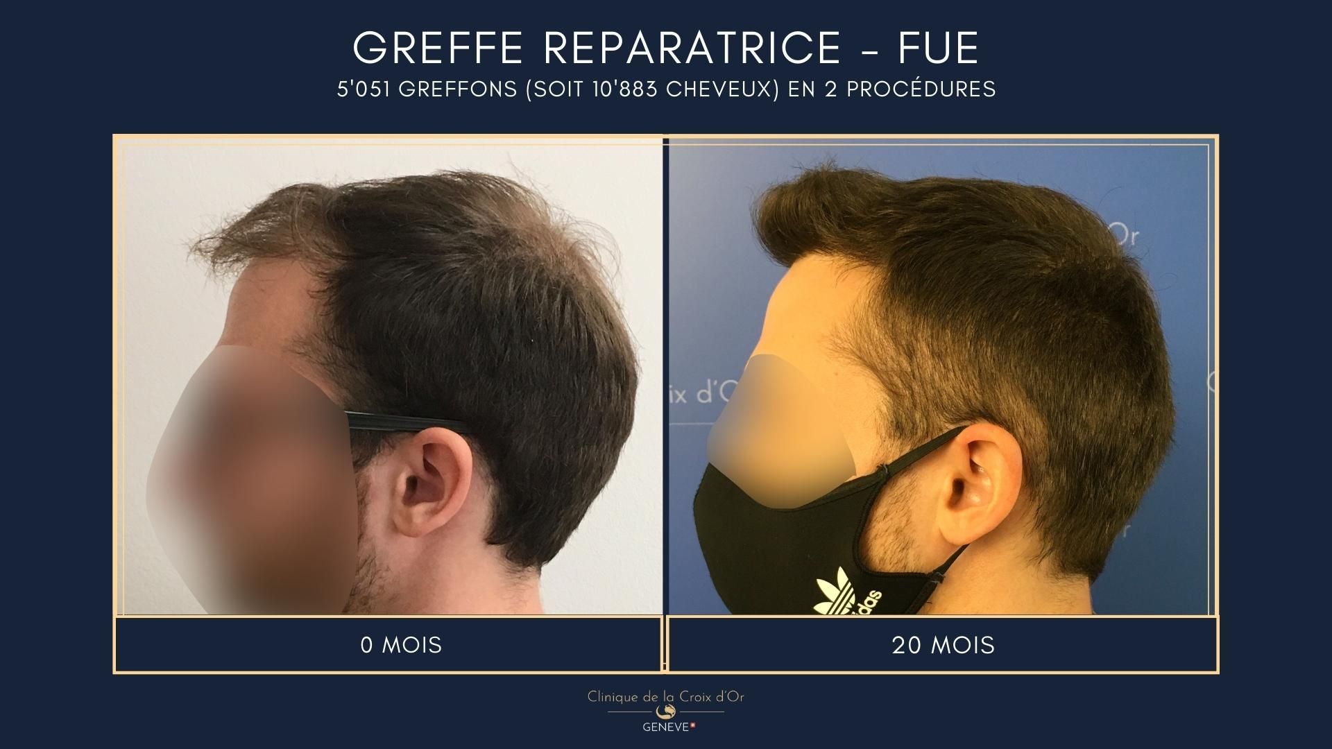 Greffe capillaire réparatrice ou correctrice