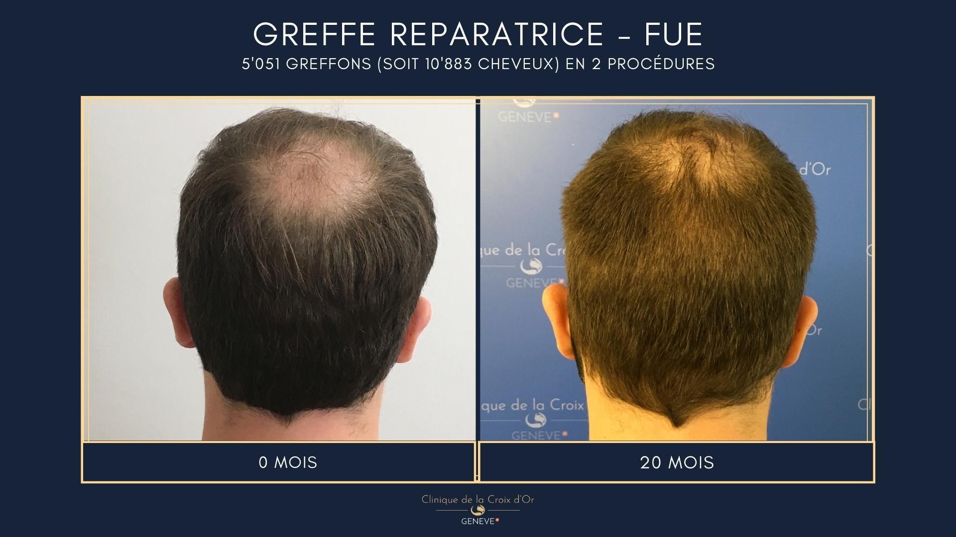 Greffe capillaire réparatrice ou correctrice