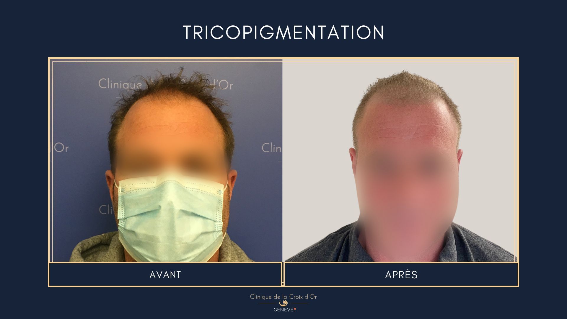 Tricopigmentation