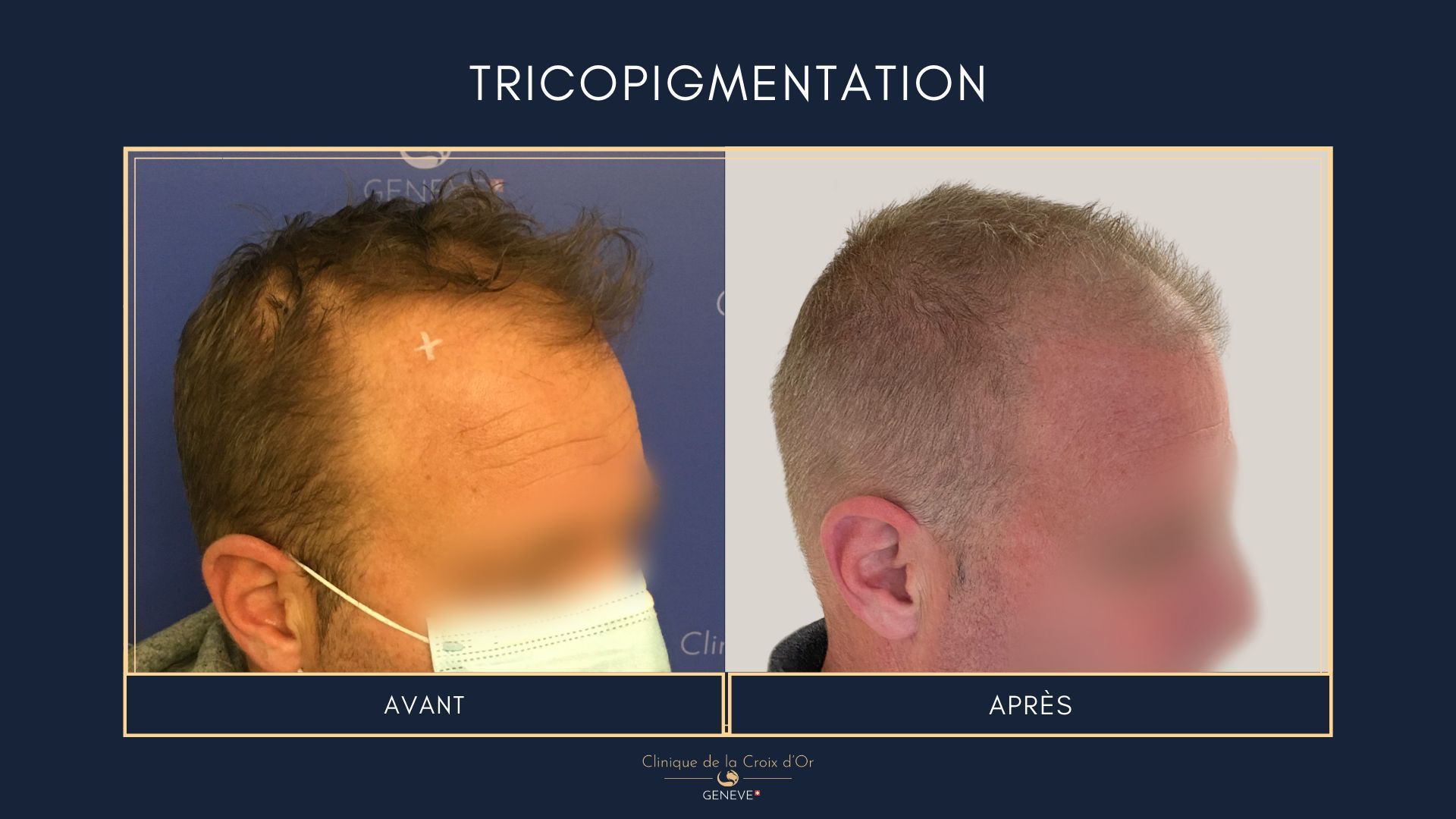 Tricopigmentation