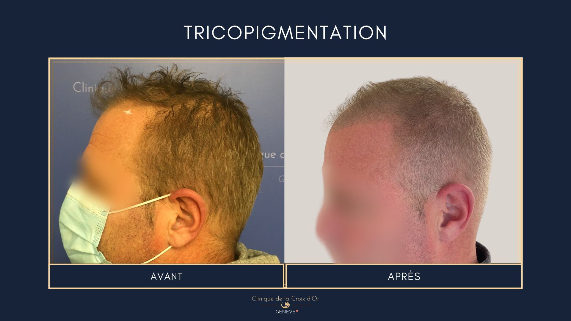 Tricopigmentation