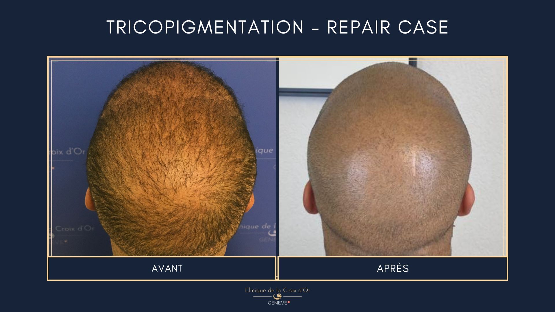 Tricopigmentation