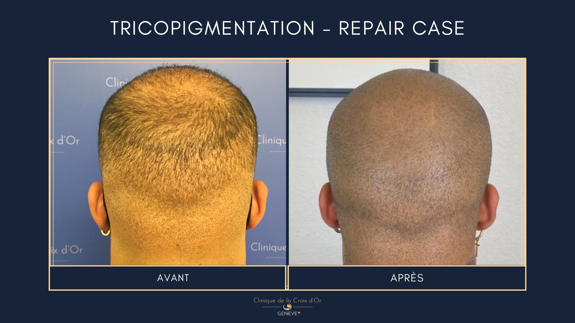 Tricopigmentation