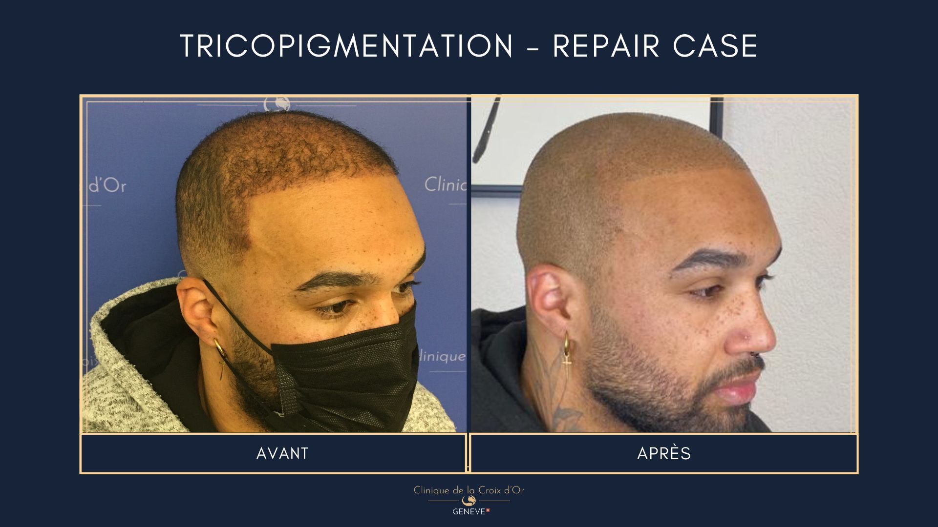 Tricopigmentation